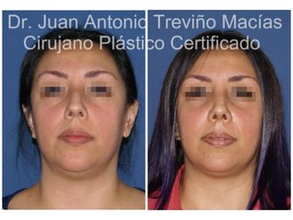Rinoplastia antes y después - 874991