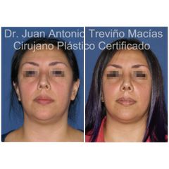 Rinoplastia - Centro de Cirugía Plástica. Dr. Juan Antonio Treviño Macías