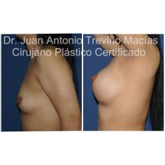 Aumento de Busto - Centro de Cirugía Plástica. Dr. Juan Antonio Treviño Macías