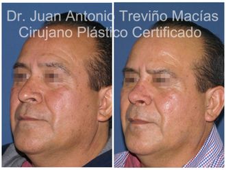 Rinoplastia antes y después - 874995