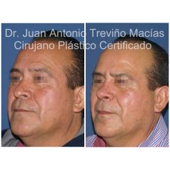 Rinoplastia - Centro de Cirugía Plástica. Dr. Juan Antonio Treviño Macías
