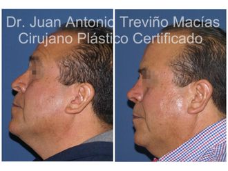 Rinoplastia antes y después - 874996