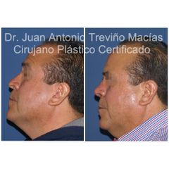 Rinoplastia - Centro de Cirugía Plástica. Dr. Juan Antonio Treviño Macías