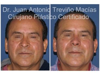 Rinoplastia antes y después - 874997