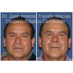 Rinoplastia - Centro de Cirugía Plástica. Dr. Juan Antonio Treviño Macías