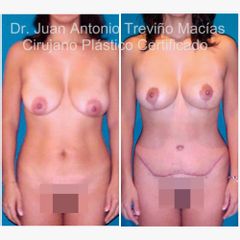 Mommy Makeover - Centro de Cirugía Plástica. Dr. Juan Antonio Treviño Macías
