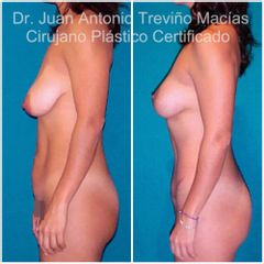 Mommy Makeover - Centro de Cirugía Plástica. Dr. Juan Antonio Treviño Macías