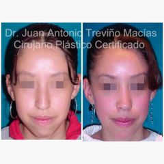 Rinoplastia - Centro de Cirugía Plástica. Dr. Juan Antonio Treviño Macías