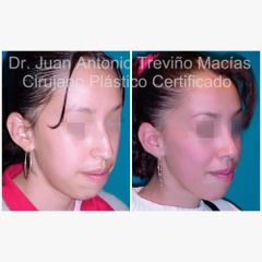 Rinoplastia - Centro de Cirugía Plástica. Dr. Juan Antonio Treviño Macías
