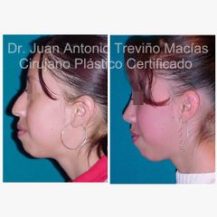 Rinoplastia - Centro de Cirugía Plástica. Dr. Juan Antonio Treviño Macías