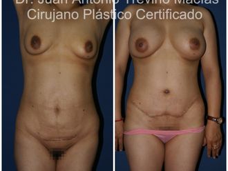 Mommy makeover antes y después - 875099