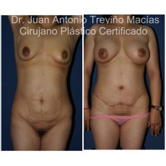 Mommy Makeover - Centro de Cirugía Plástica. Dr. Juan Antonio Treviño Macías