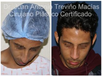 Rinoplastia antes y después - 875100