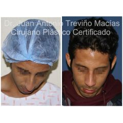 Rinoplastia - Centro de Cirugía Plástica. Dr. Juan Antonio Treviño Macías