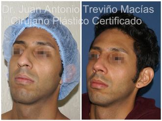 Rinoplastia antes y después - 875101