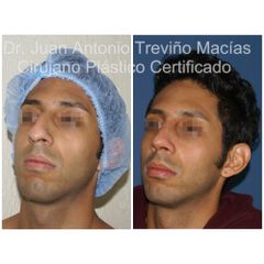 Rinoplastia - Centro de Cirugía Plástica. Dr. Juan Antonio Treviño Macías