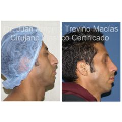 Rinoplastia - Centro de Cirugía Plástica. Dr. Juan Antonio Treviño Macías