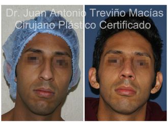 Rinoplastia antes y después - 875103