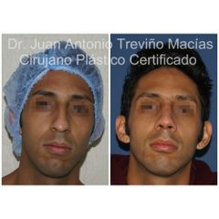 Rinoplastia - Centro de Cirugía Plástica. Dr. Juan Antonio Treviño Macías