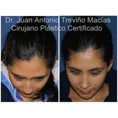 Rinoplastia - Centro de Cirugía Plástica. Dr. Juan Antonio Treviño Macías
