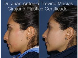 Rinoplastia antes y después - 875105