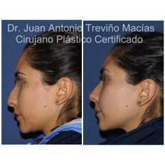 Rinoplastia - Centro de Cirugía Plástica. Dr. Juan Antonio Treviño Macías