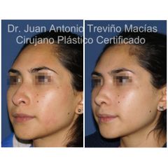 Rinoplastia - Centro de Cirugía Plástica. Dr. Juan Antonio Treviño Macías