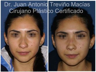 Rinoplastia antes y después - 875107