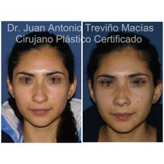 Rinoplastia - Centro de Cirugía Plástica. Dr. Juan Antonio Treviño Macías