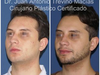 Rinoplastia antes y después - 875108