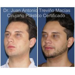 Rinoplastia - Centro de Cirugía Plástica. Dr. Juan Antonio Treviño Macías