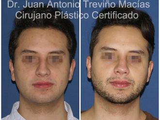 Rinoplastia antes y después - 875109