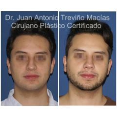 Rinoplastia - Centro de Cirugía Plástica. Dr. Juan Antonio Treviño Macías
