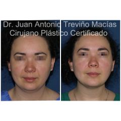 Cirugia Facial - Centro de Cirugía Plástica. Dr. Juan Antonio Treviño Macías