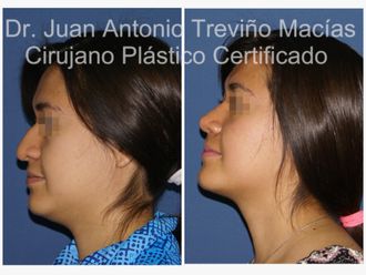 Rinoplastia antes y después - 875111