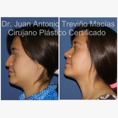 Rinoplastia - Centro de Cirugía Plástica. Dr. Juan Antonio Treviño Macías