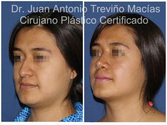 Rinoplastia antes y después - 875112