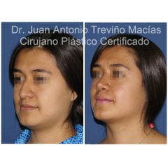 Rinoplastia - Centro de Cirugía Plástica. Dr. Juan Antonio Treviño Macías