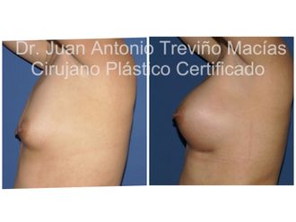 Aumento de busto antes y después - 875113