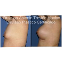 Rinoplastia - Centro de Cirugía Plástica. Dr. Juan Antonio Treviño Macías