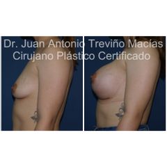 Aumento de Busto - Centro de Cirugía Plástica. Dr. Juan Antonio Treviño Macías