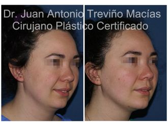 Cirugía facial antes y después - 875119