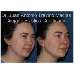 Cirugia Facial- Centro de Cirugía Plástica. Dr. Juan Antonio Treviño Macías