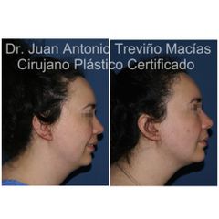 Cirugia Facial - Centro de Cirugía Plástica. Dr. Juan Antonio Treviño Macías