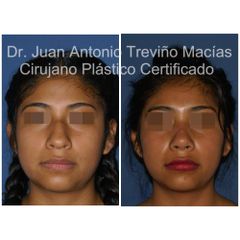 Rinoplastia - Centro de Cirugía Plástica. Dr. Juan Antonio Treviño Macías