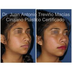Rinoplastia - Centro de Cirugía Plástica. Dr. Juan Antonio Treviño Macías