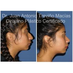Rinoplastia - Centro de Cirugía Plástica. Dr. Juan Antonio Treviño Macías