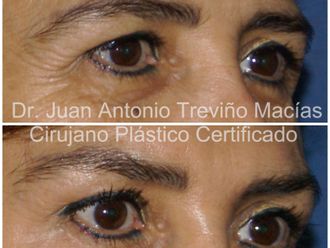 Blefaroplastia antes y después - 875552
