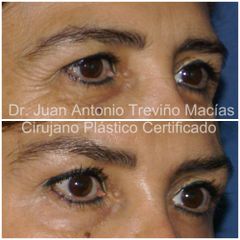 Blefaroplastia - Centro de Cirugía Plástica. Dr. Juan Antonio Treviño Macías