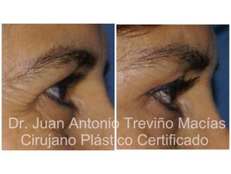 Blefaroplastia antes y después - 875553